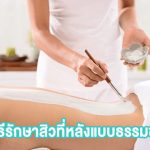 วิธีการรักษาสิวที่หลังแบบธรรมชาติ
