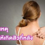 สิวที่หลังเกิดจากอะไร-7-สาเหตุ-ที่ทำให้เป็นสิวที่หลัง